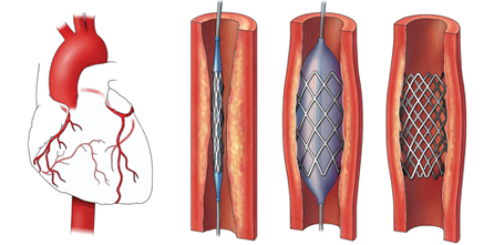 Doctor dominicano asegura haber creado técnica cardiovascular para evitar reestenosis por colocación